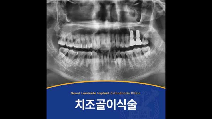 동탄임플란트치과, 치조골이식술로 더 튼튼하게 식립한 사례! : 네이버 블로그