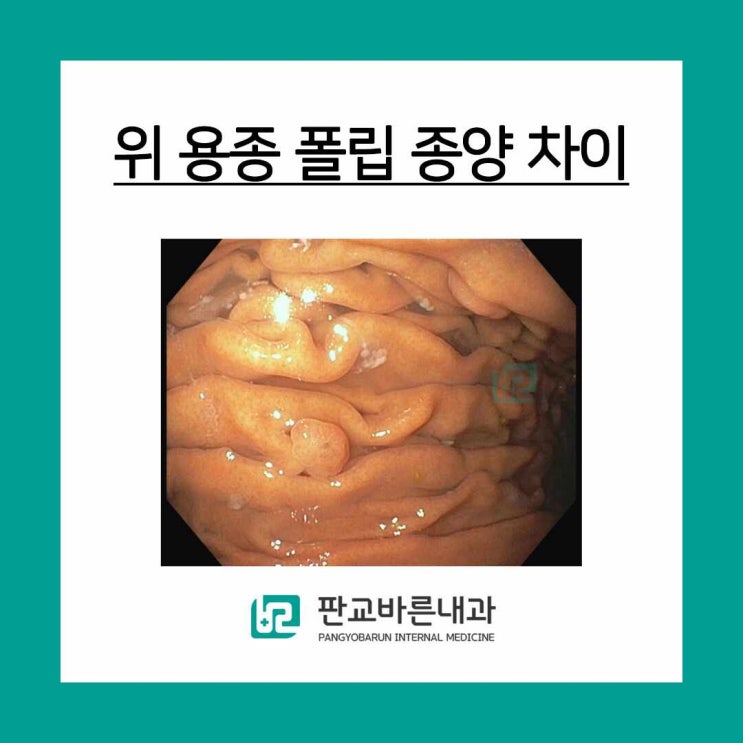 위 용종 폴립 종양 어떤 차이인가요? : 네이버 블로그