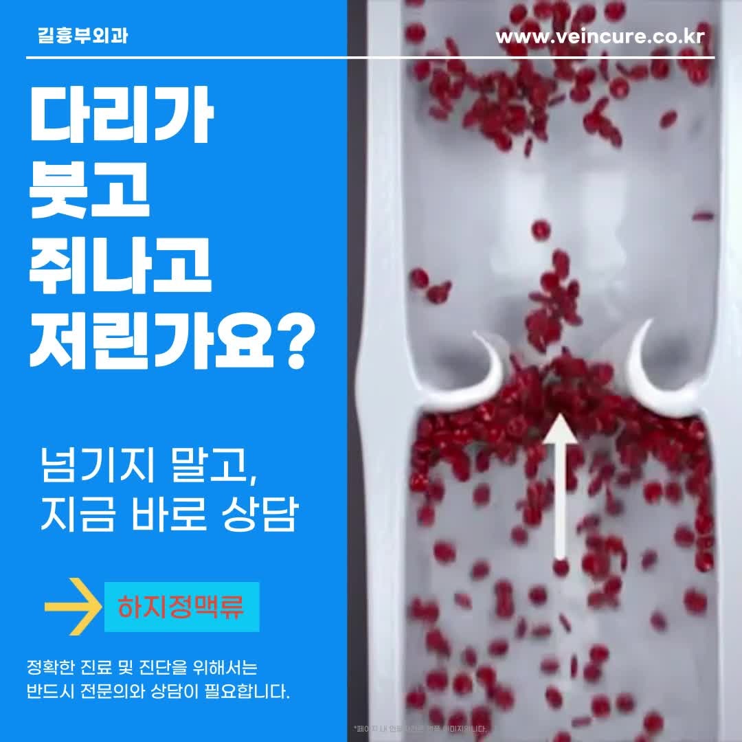 김해하지정맥류 다리가 쉽게 붓고 피곤해지고 쥐가 난다면