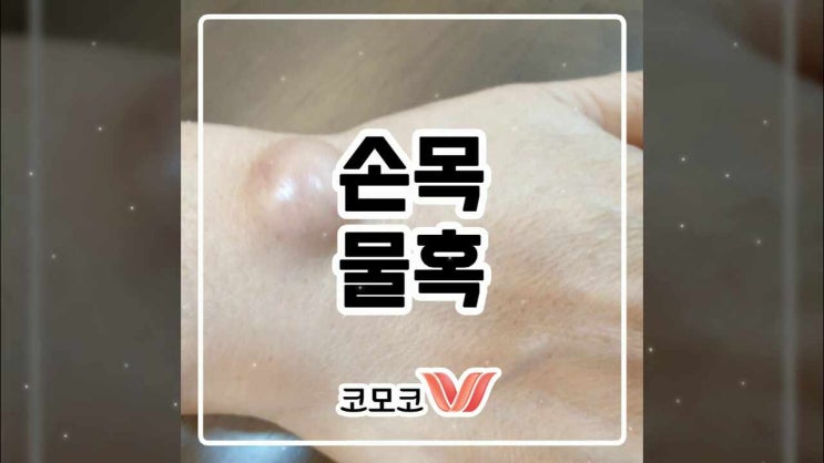 손목 물혹 원인과 결절종 부위에 따른 통증 : 네이버 블로그