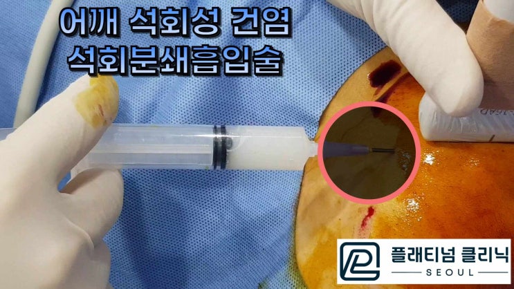 (플래티넘의원) 어깨 석회성 건염. 수술없이 치료. 석회분쇄흡입술!