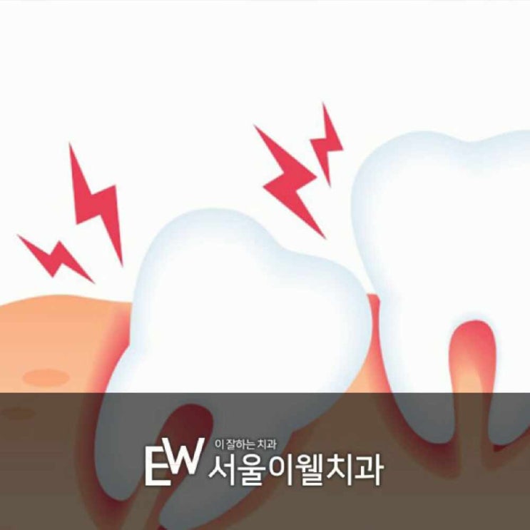 서초구치과 사랑니 발치 후 찜질, 붓기에 도움이 되나요? : 네이버 블로그