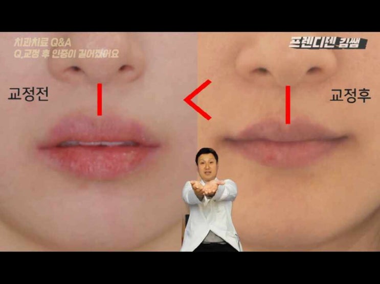 강남역교정치과 비발치교정 vs 발치교정 결정의 척도는? : 네이버 블로그