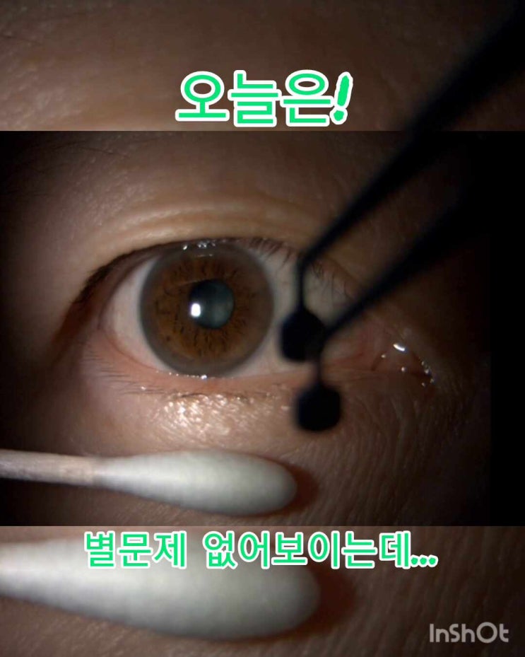  [성내 둔촌 암사 근처 천호역 그랜드성모안과] 녹내장 안약 쓰는데 불편할때 눈꺼풀 기름 짜기