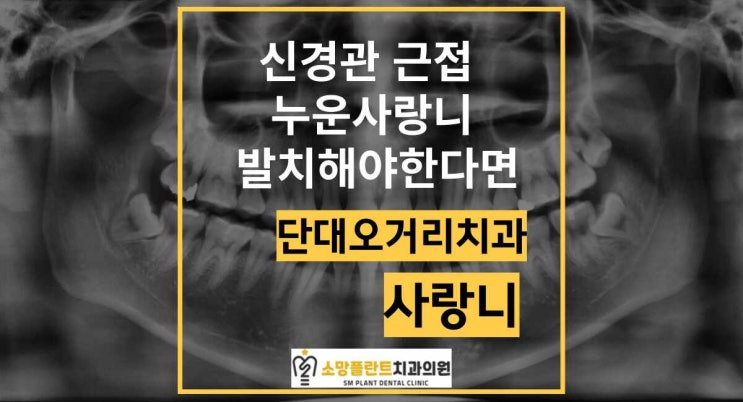  신경 근접 누운사랑니 발치 걱정하고 있다면   단대오거리치과