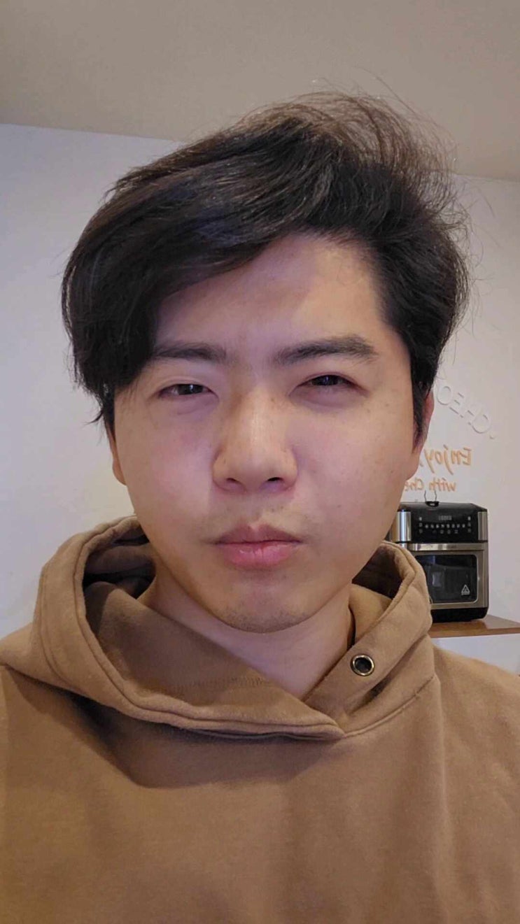  터키 모발이식 : 모발이식을 받을 수 없는 유형