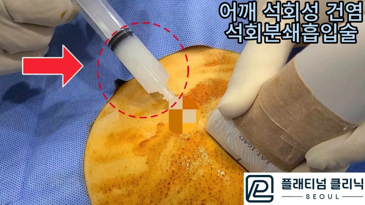 (플래티넘의원) 어깨 석회성 건염. 아무리 충격파 치료 해도 호전없는 딱딱한 석회도 비수술적으로 해결할 수 있는 치료는?