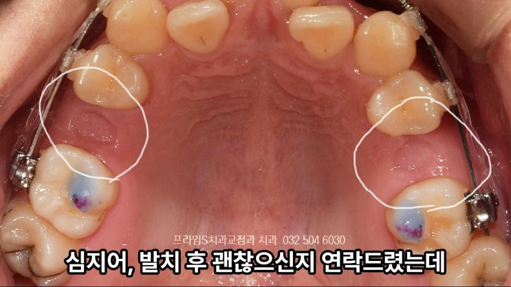 치아교정 발치(소구치), 많이 아픈가요? 부천부정교합 : 네이버 블로그