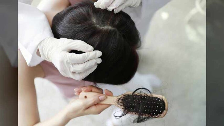  부산탈모성지 모발탈락 유형과 관리 방법은