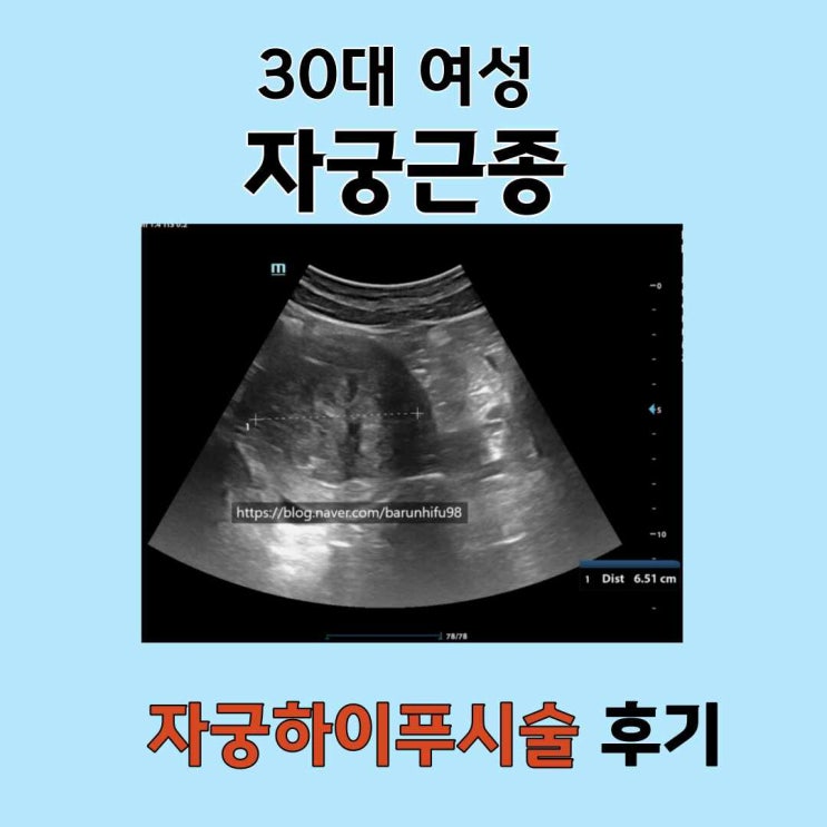  30대 미혼여성 자궁근종 6-7Cm 하이푸 시술 후기