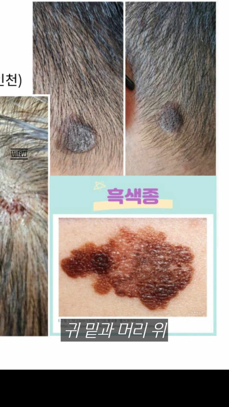  아스타잔틴이 들어 있는 메가멜로시라 흑색종을 죽여버려
