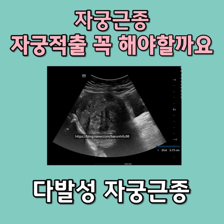  자궁적출수술 반드시 필요할까?자궁 11Cm 다발성근종 빈혈 치료 사례