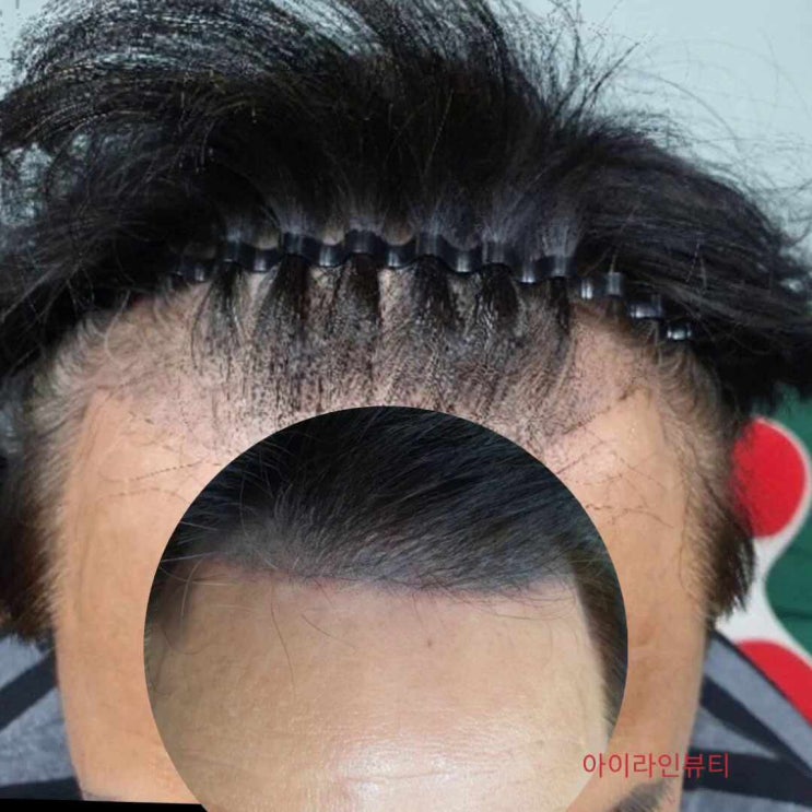 전주 헤어라인 smp문신후 염색은 언제 가능할까?