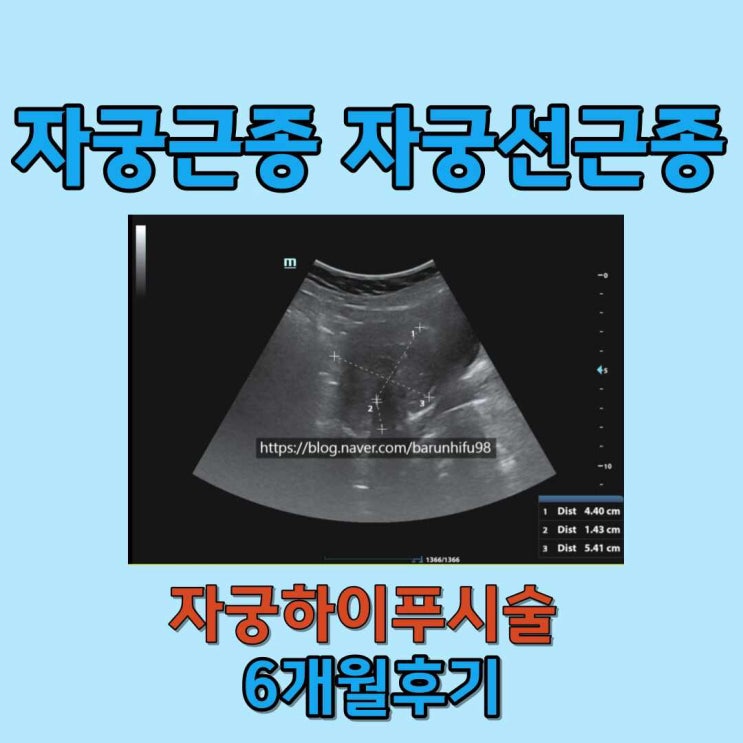  자궁근종 자궁선근종 자궁하이푸 6개월 경과