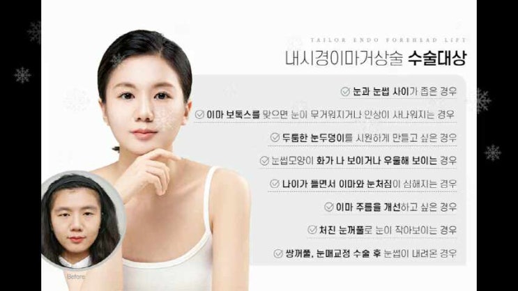 이마거상효과 미간 사이에 생긴 미간 주름까지 해결 : 네이버 블로그