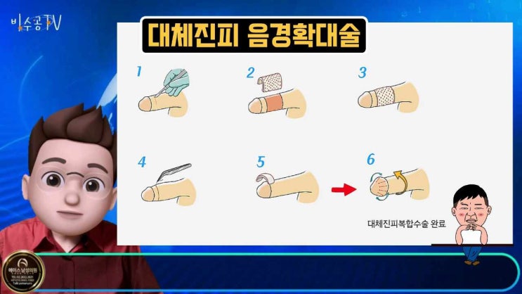  성기확대 수술은 대체진피로!!