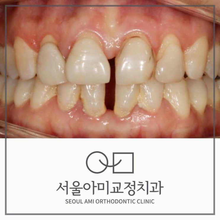  인천연수동치과 벌어진 앞니를 개선하고 싶다면