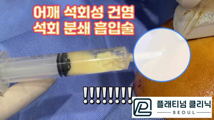 극심한 통증을 일으키는 어깨 석회성건염. 1번의 시술로 통증에서 해결!!! 석회분쇄흡입술 - 강남 신사역 플래티넘의원