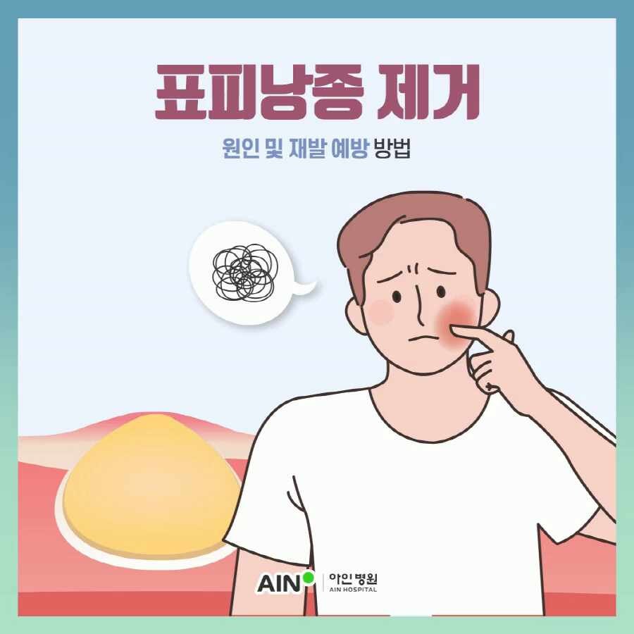 인천표피낭종 제거 원인 및 재발 예방 방법