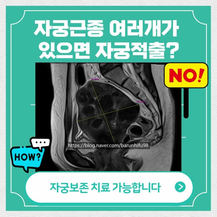  자궁근종증상  근종 6.5Cm 6Cm 자궁하이푸 치료 사례