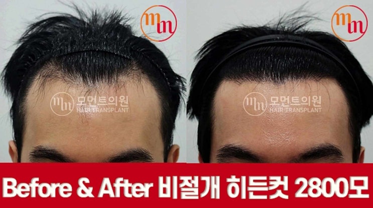  M자모발이식 비용보다 중요한 것은