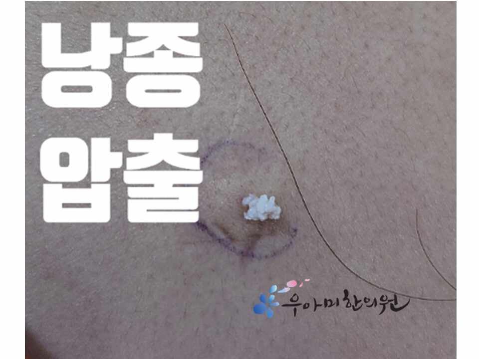 회음부 염증 낭종으로 커진다면?