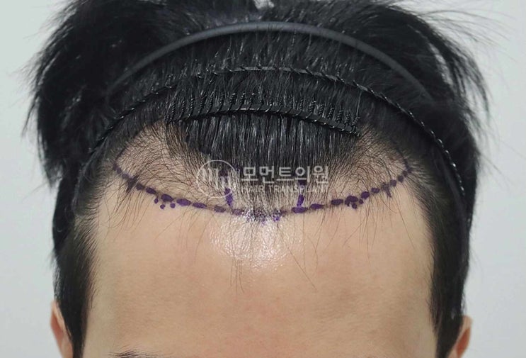  헤어라인교정가격 저렴하다고 좋은 게 아닌 이유
