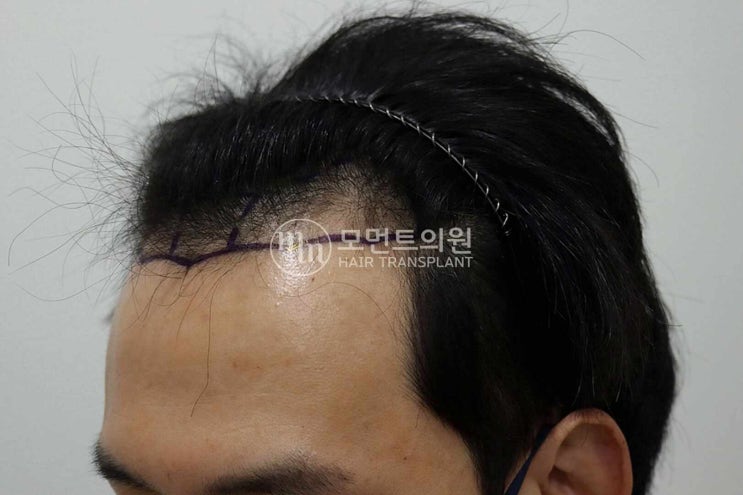  M자모발이식 수술 시간 과정에 따라