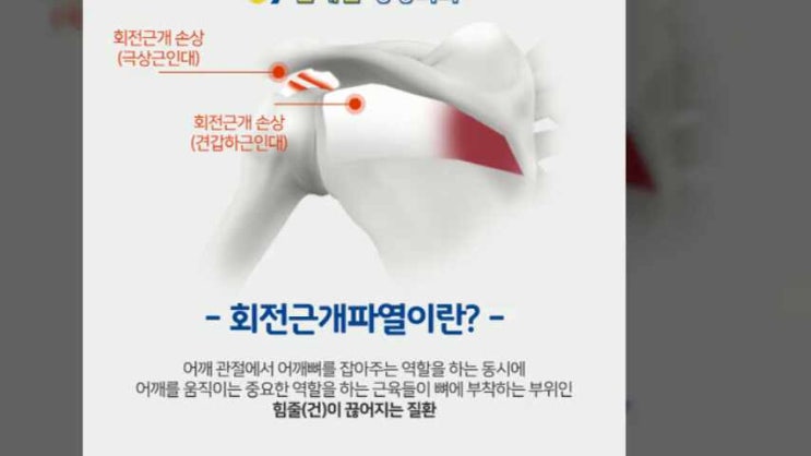 회전근개파열 운동치료, 효과적인 방법이 궁금하시다면! : 네이버 블로그