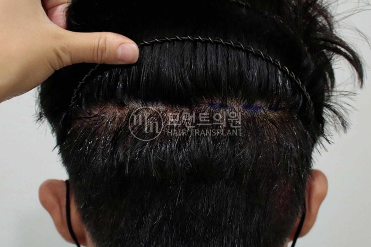  절개 비절개 모발이식 수술 통증 흉터 부담된다면
