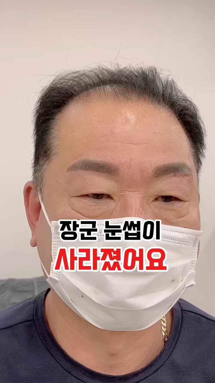  남자눈썹문신제거후 눈썹문신했어요