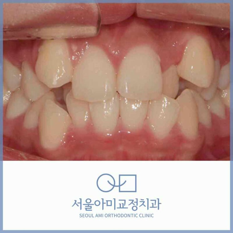  미추홀구교정치과 덧니 발치로 가지런하게