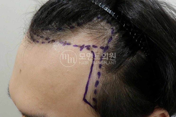  모발이식재수술 부작용 고민 중이라면