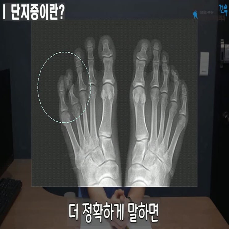 단지증 수술 치료법 발가락 길이 짧은 원인 유전 : 네이버 블로그