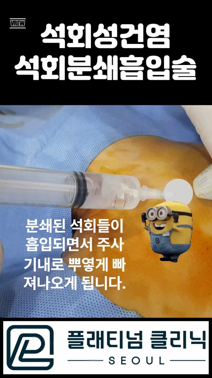 (강남어깨병원, 플래티넘의원) 어깨 석회성 건염으로 고통받지 말고 한번의 시술로 통증에서 벗어나시길 바랍니다.