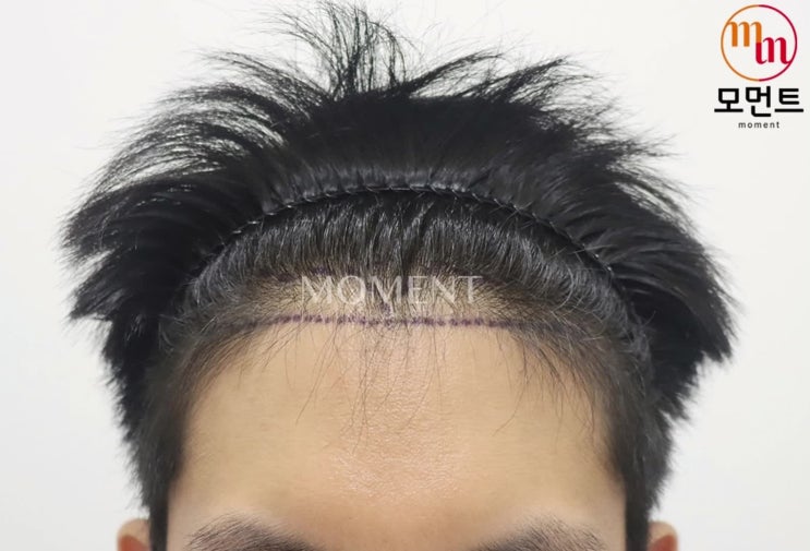  앞머리 모발이식 비용 수술 가격 비교