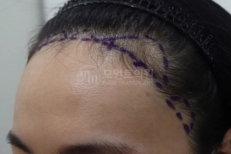  여성헤어라인교정 탈모로 수술 고민 중이라면