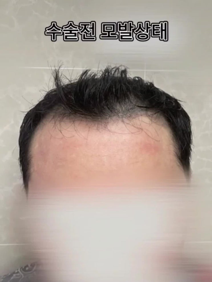  터키 모발이식 16일차 보고