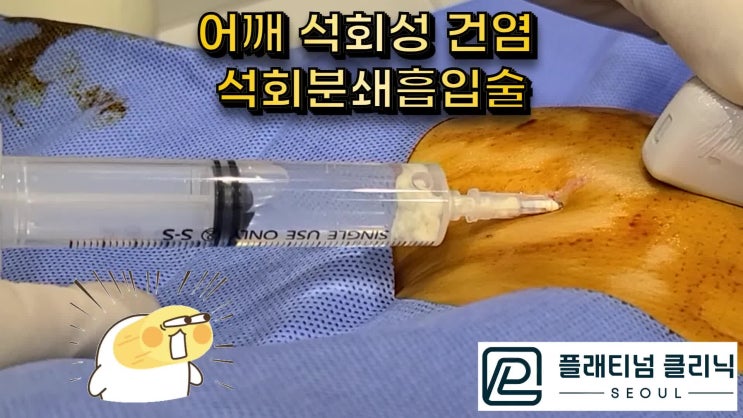 임산부도 3cm 석회성건염 수술 없이 안전하게 바로 석회제거시술이 가능합니다.