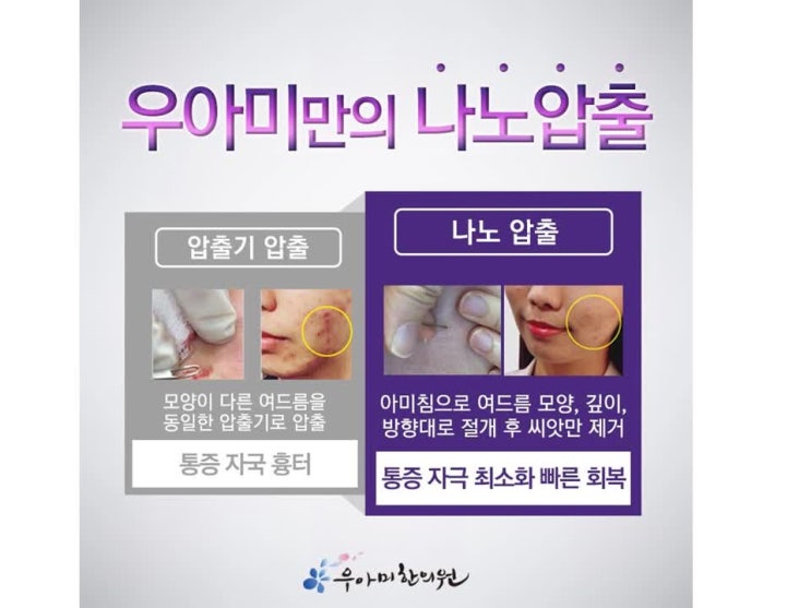 여드름 압출 고통으로 힘들다면? 달인 원장을 찾으세요 네이버 블로그