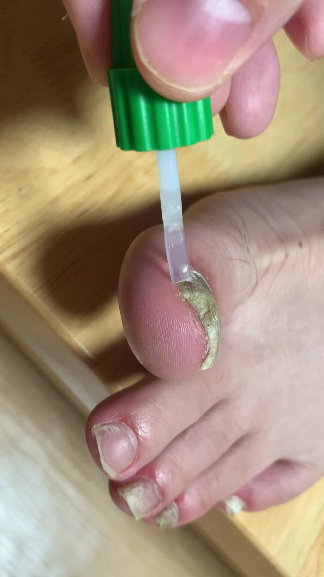 5ml 바르지오 발톱 무좀 치료제 네일라카 총정리