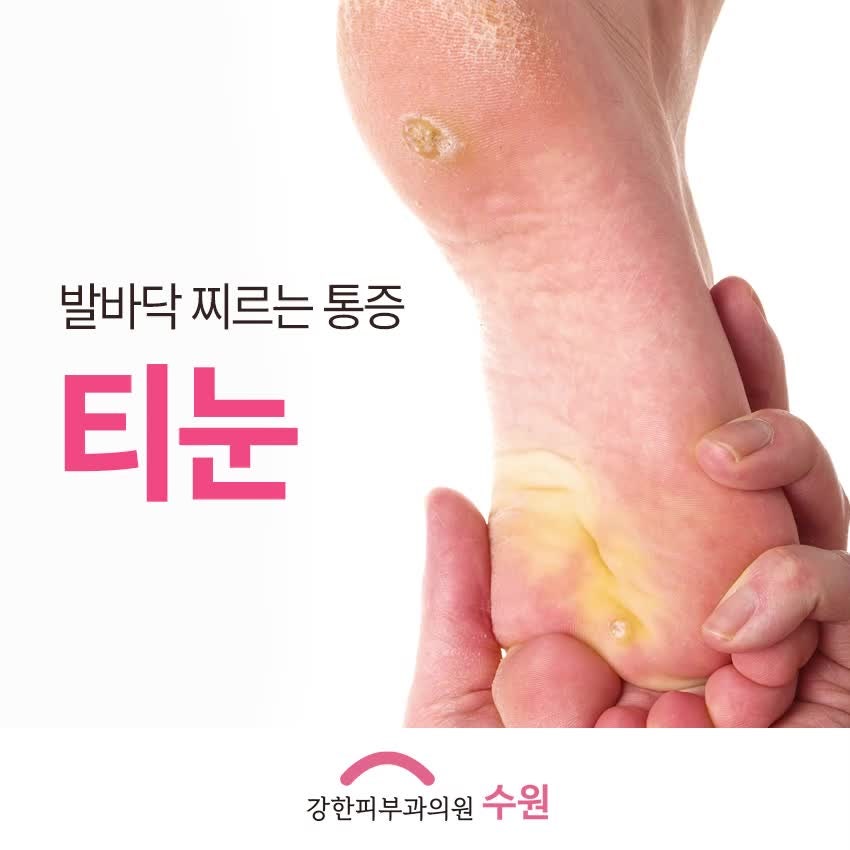 수원 팔달구 피부과 발바닥 찌르는 통증