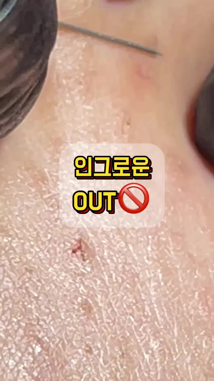  부산 울산 왁싱 전문점 아쿠아왁싱에서 알려주는 인그로운 헤어