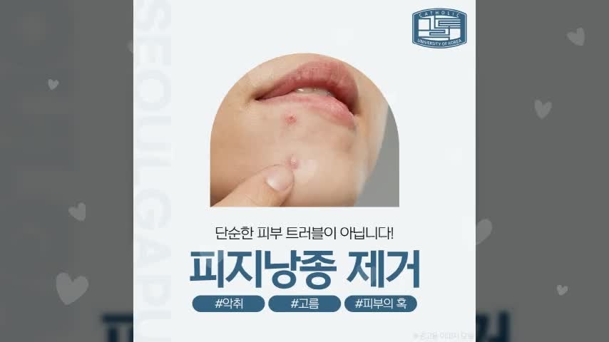 광주피지낭종 제거? '이것' 모르면 재발할 수 있습니다.