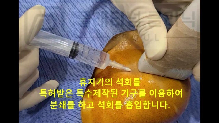 석회성건염 치료 한번에 해결됩니다.