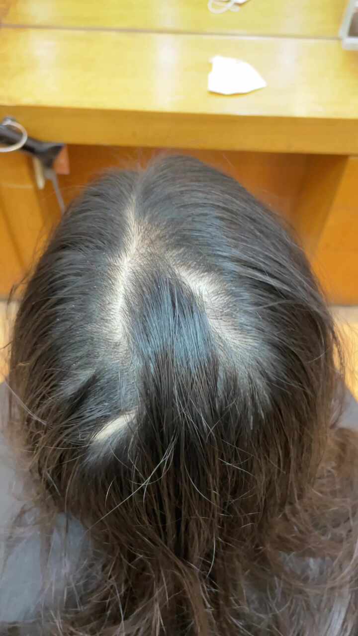  여성탈모고민 정수리와가마갈라짐흉터 탈모교정성형펌과두피케어로고민타파! 부산사상르네시떼6층위치미용실 사상구홈플러스7층위치