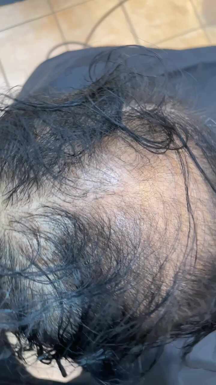  셀프염색과모발극손상이함께온 시니어여성탈모 이를어쩌나 너무심해요! 차근차근노력해봅시다 여기는헤어토탈클리닉전문미용실입니다