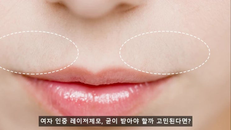 여자 인중 레이저제모, 받을까 말까 고민된다면? [맑은결의원 작성] : 네이버 블로그