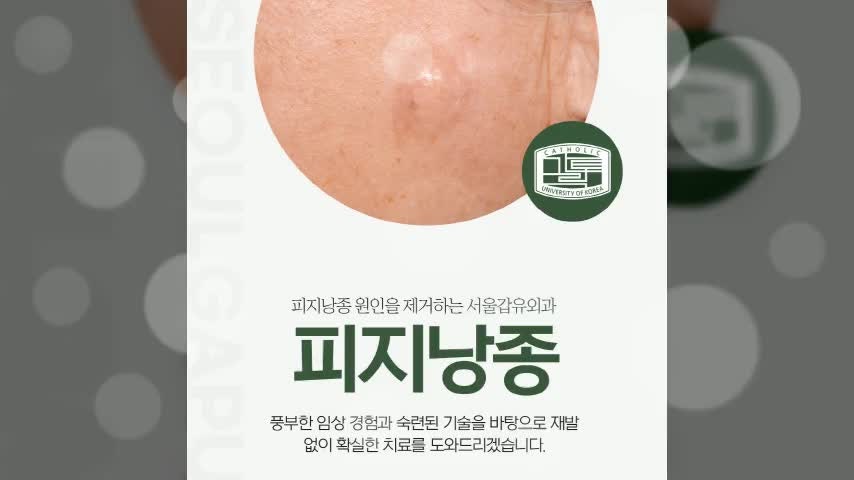 광주피지낭종 제거 방법부터 주의사항까지 제대로 알고 받으세요!