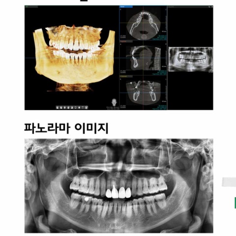 [클립] 저선량 그린CT와 엑스레이, 얼마나 안전할까요?